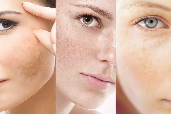 Can melasma be cured?