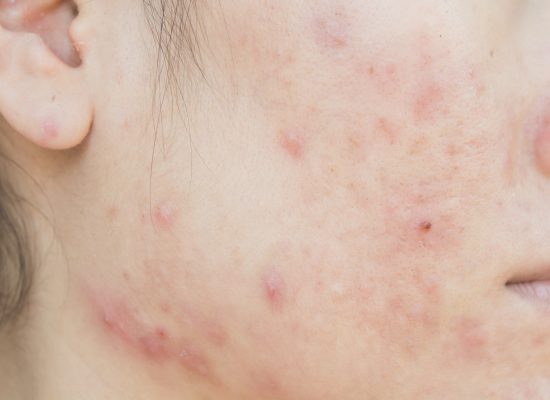 Skin irritation, allergies